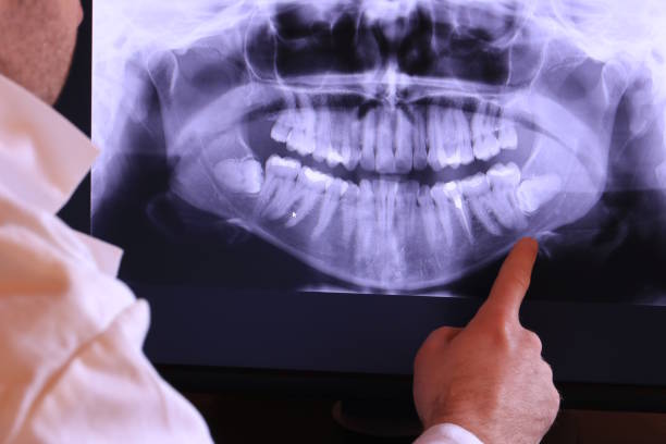 Best Emergency Wisdom Teeth Removal in Richville, OH