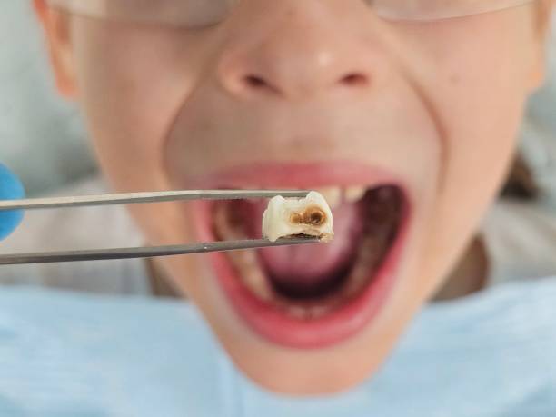 Best Emergency Treatment for Dental Infections or Abscesses in Richville, OH